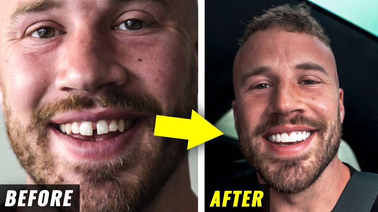 Fixing My Teeth After 31 Years (emotional)