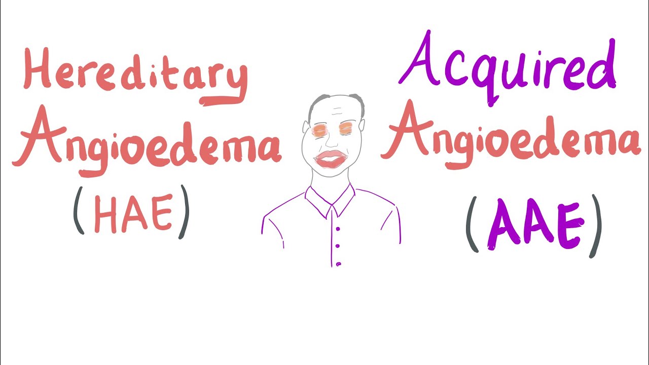 Hereditary Angioedema vs. Acquired angioedema