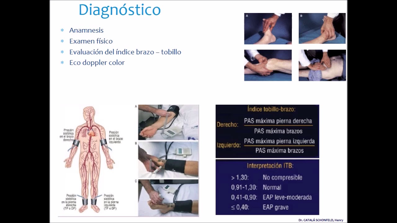 Arteriopat&iacute;a  Obstructiva  Cr&oacute;nica. Resumen en 2 min.