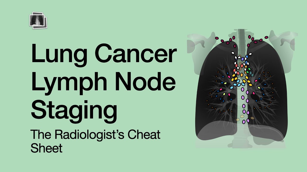 Lung Cancer Lymph Node Staging: The Radiologist's Cheat Sheet