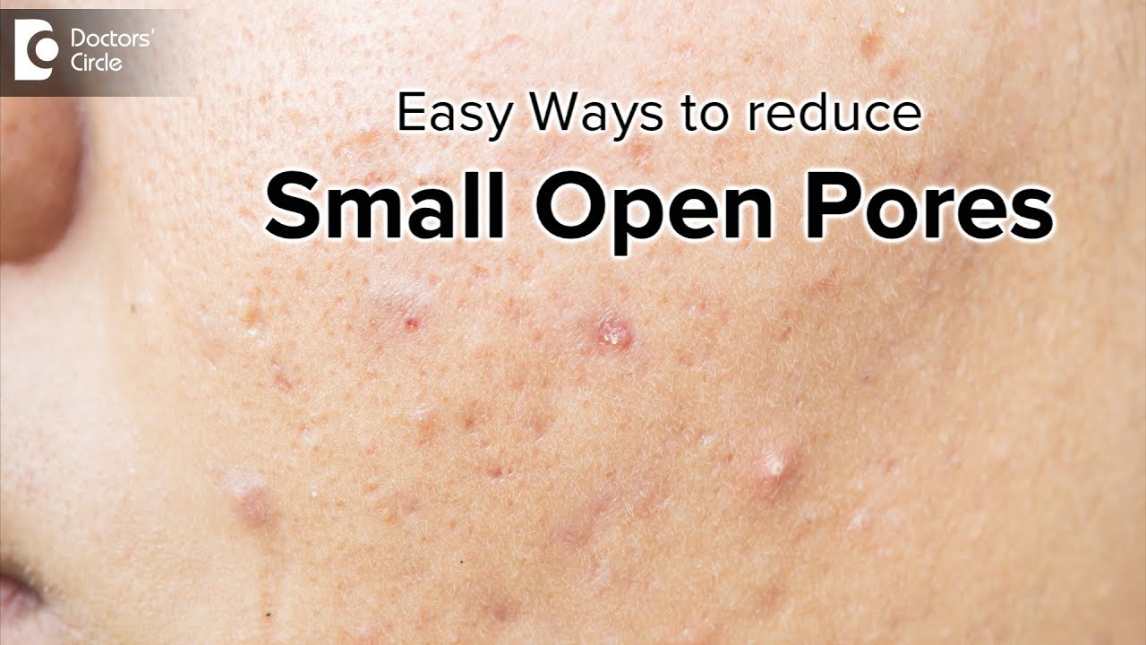 What causes pores on face? | Treatment of Small Open Pores - Dr. Rajdeep Mysore