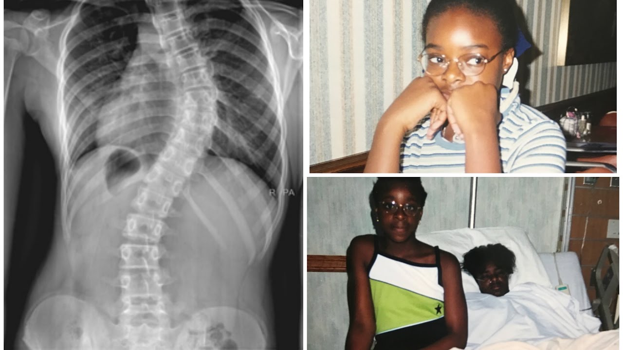 April Vlogs #4 | My Scoliosis Story - IfyYvonne