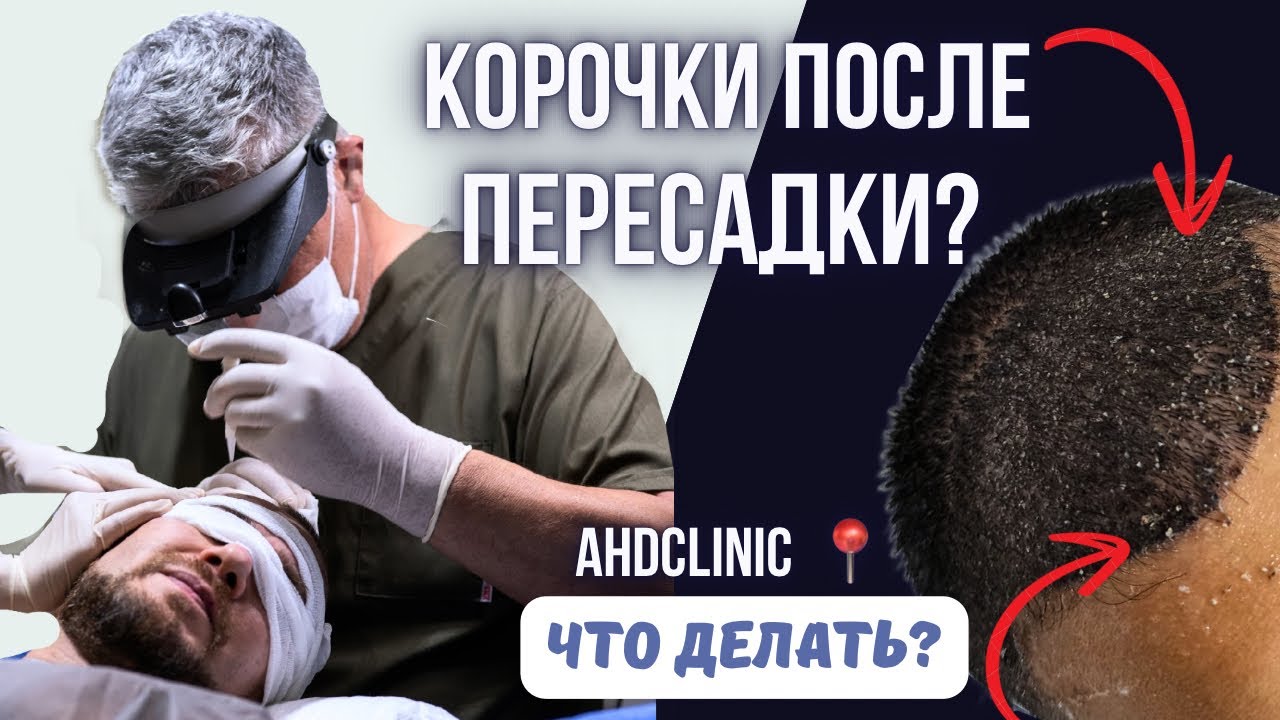 КОРОЧКИ ПОСЛЕ ПЕРЕСАДКИ ВОЛОС. ЧТО С НИМИ ДЕЛАТЬ?