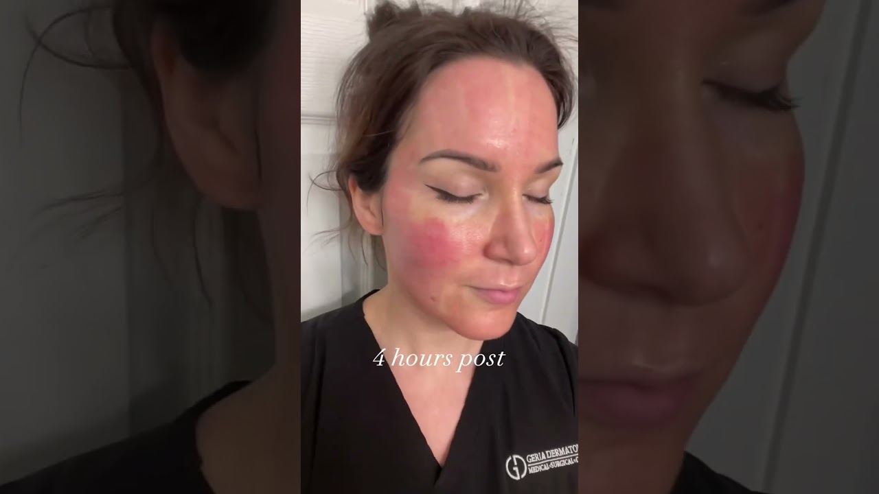 Cool Peel #njdermatology #njdermatologist #coolpeel #coolpeellaser #acnescars #acnescarstreatment