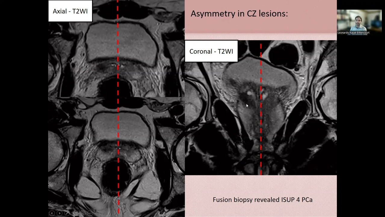 Pitfalls in Prostate MRI