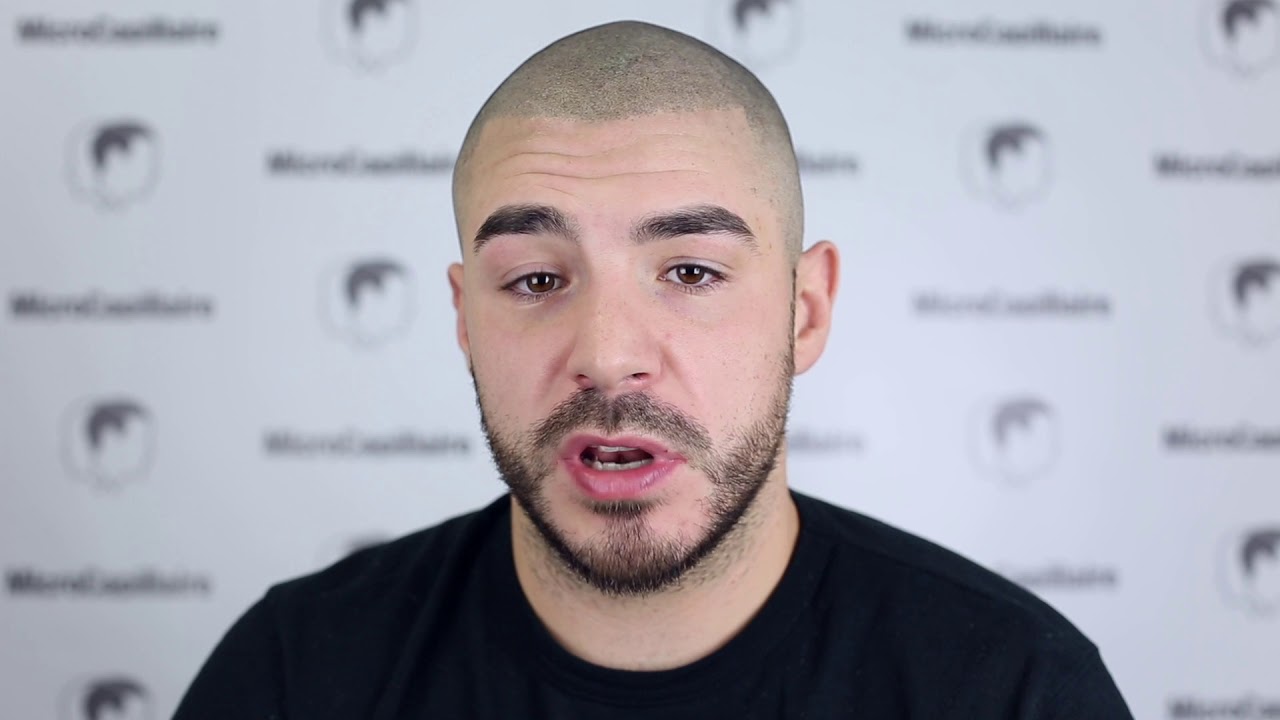 Does scalp micropigmentation capillaire look real? Mathieu Germain | Clinique MicroCapillaire