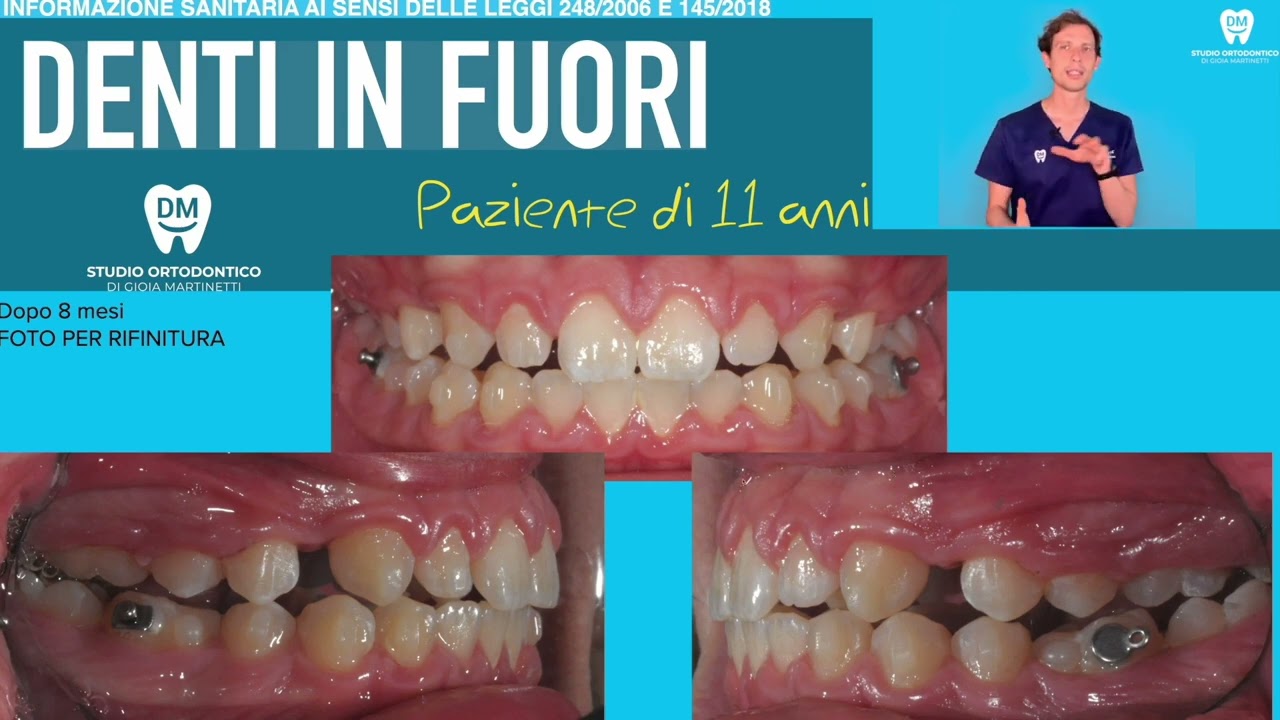 🇬🇧 Protruding Teeth – Class II: The Role of Braces, Aligners, and Clear Trays!