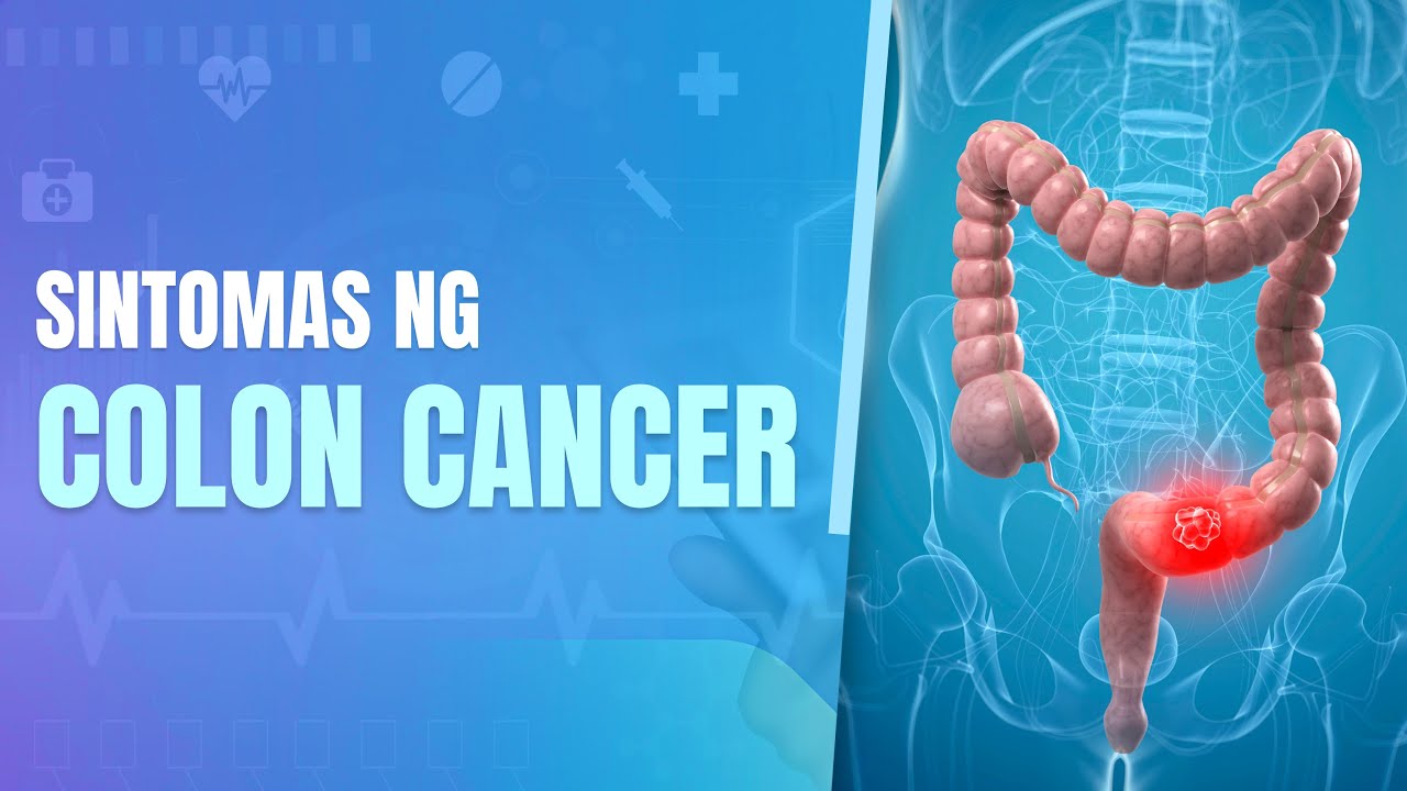 COLON CANCER: Prevention and Treatment