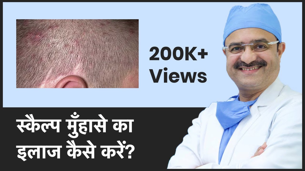 Acne/Pimples On Scalp: How to treat Acne On Scalp (स्कैल्प मुँहासे का इलाज कैसे करें) | (In HINDI)