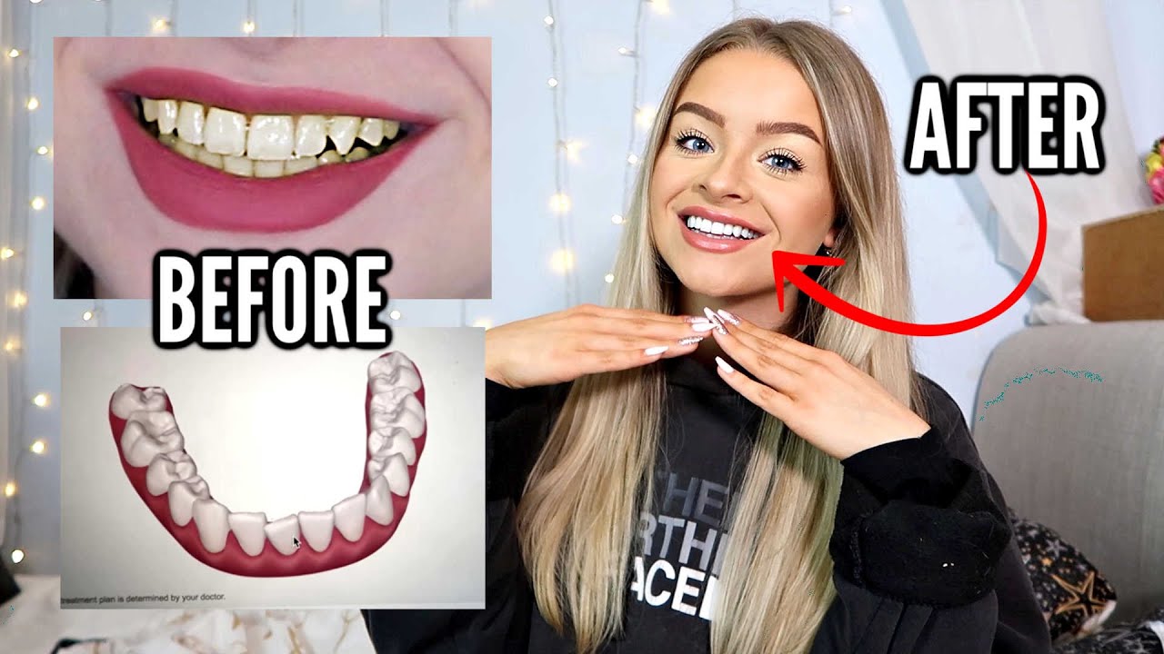 КАК Я ВЫЛЕЧИЛ ЗУБЫ. ОПЫТ INVISALIGN — ПЛЮСЫ, МИНУСЫ, ЦЕНА И Т.Д.