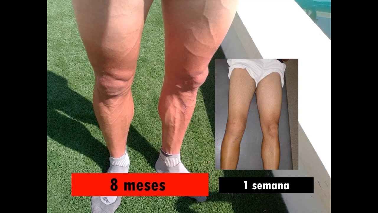Recuperación completa LIGAMENTO CRUZADO ANTERIOR  Desde semana 1 hasta semana 14    Buen trabajo