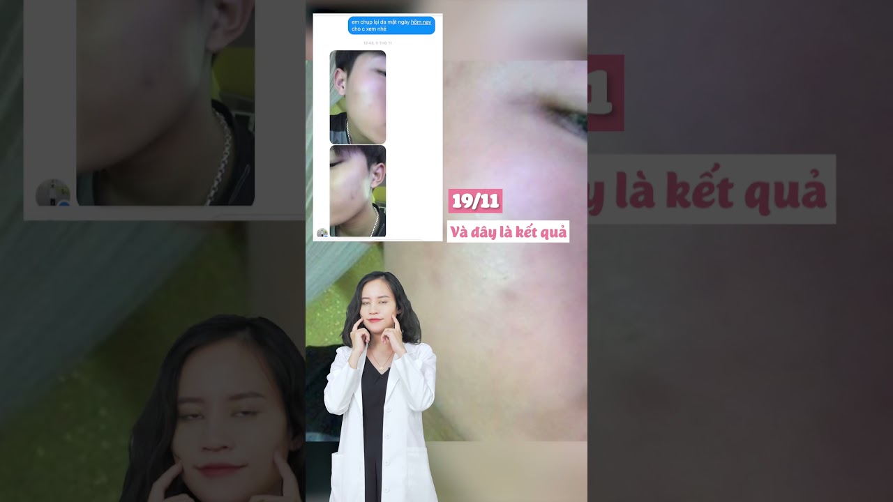 H&agrave;nh tr&igrave;nh 3 th&aacute;ng trị th&acirc;m c&ugrave;ng b&aacute;c sĩ da liễu! #tham #tritham #bacsidalieu