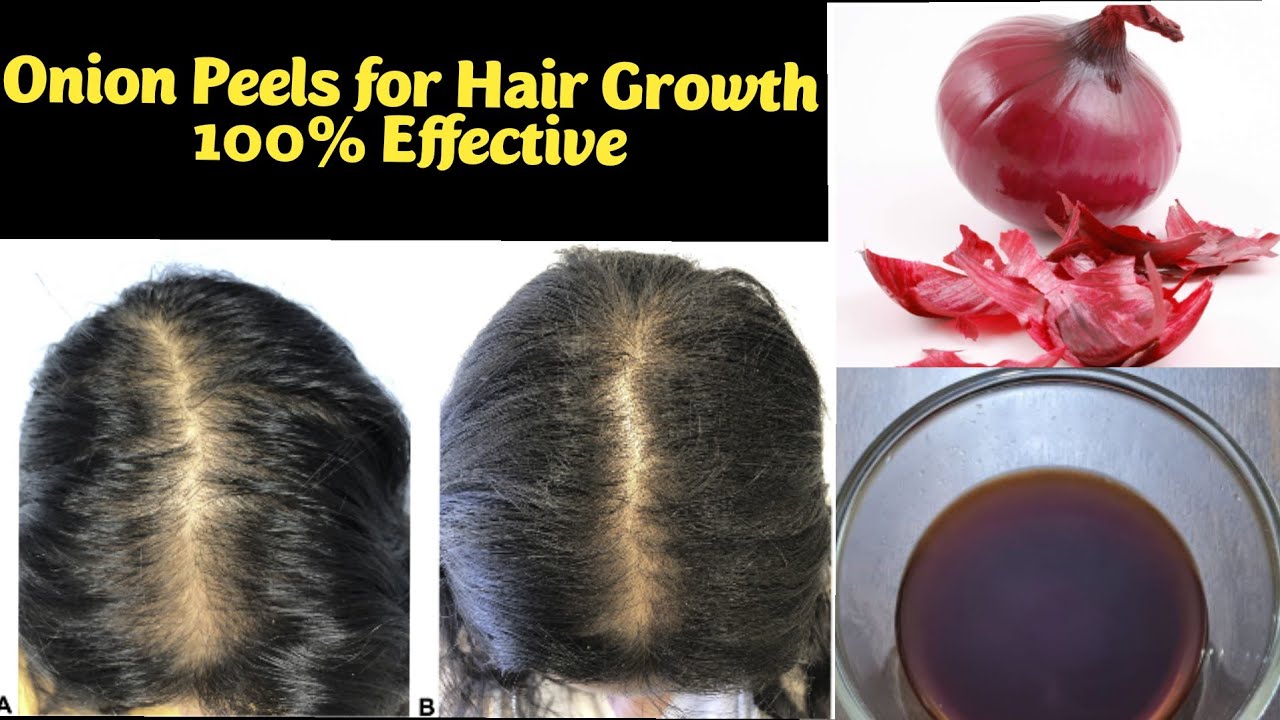 Onion Peel for Hair growth | How to use onion peel for Hair growth| Best hair toner @Littlecloves