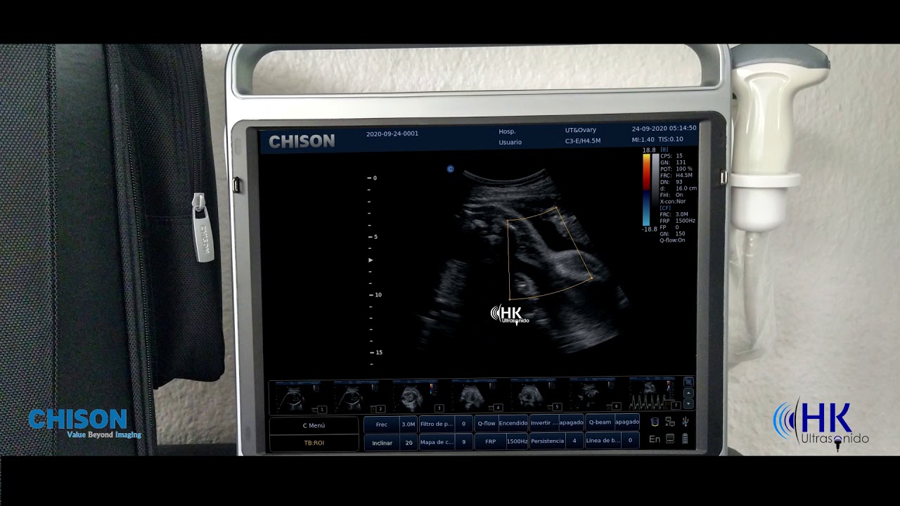 Chison EBit 50 Doppler Color - Ultrasonido HK