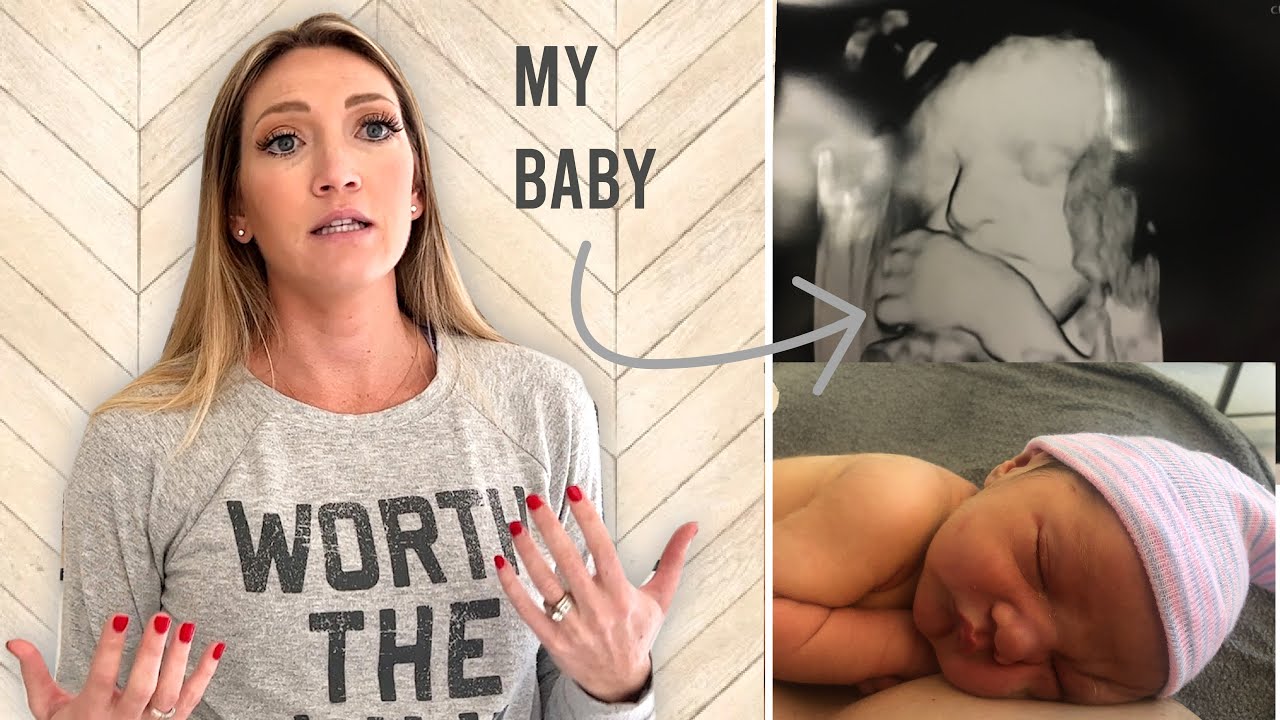 Does Echogenic Bowel Mean Down Syndrome? - My Story