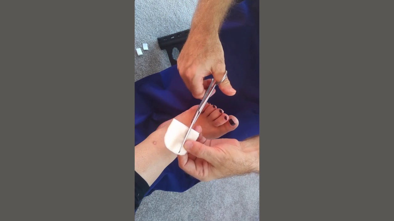 Instruction on how to use our 5mm Felt Chiropody Padding