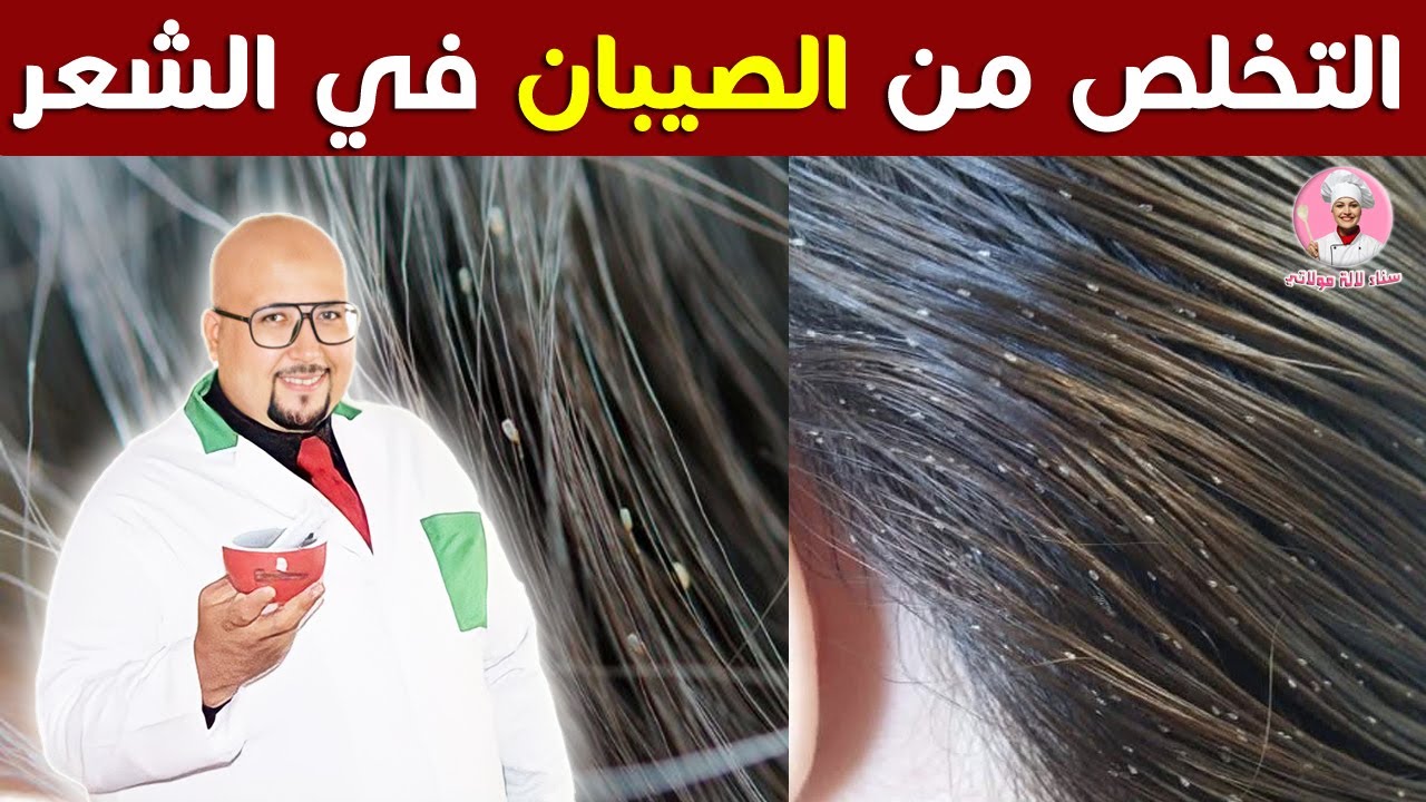 وصفة للتخلص من الصيبان في الشعر من عند الدكتور عماد ميزاب imad mizab
