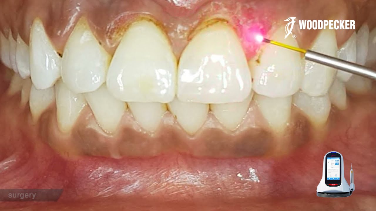 Woodpecker Laser Case Sharing - Gum Contouring & Gum depigmentation & Teeth Whitening