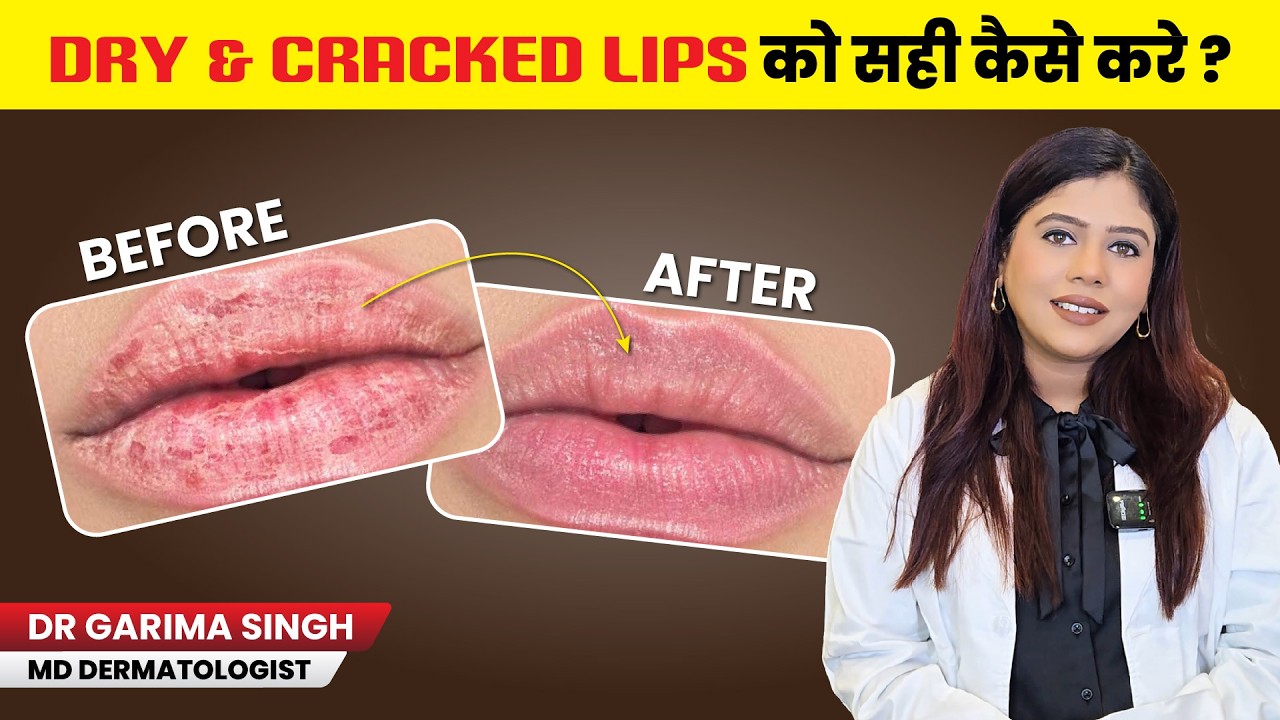 Cracked Lips Ka Asli Reason | Dry & Chapped Lips Treatment Tips | Dermatologist