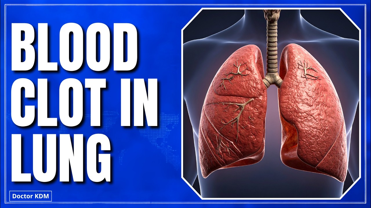 Blood Clot Symptoms You Can't Ignore | Doctor Explains