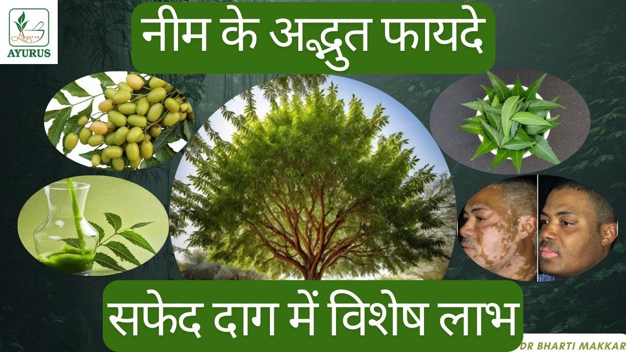 Neem: An amazing herb, special benefits in Vitiligo by Dr Bharti Makkar, Ayurveda physican