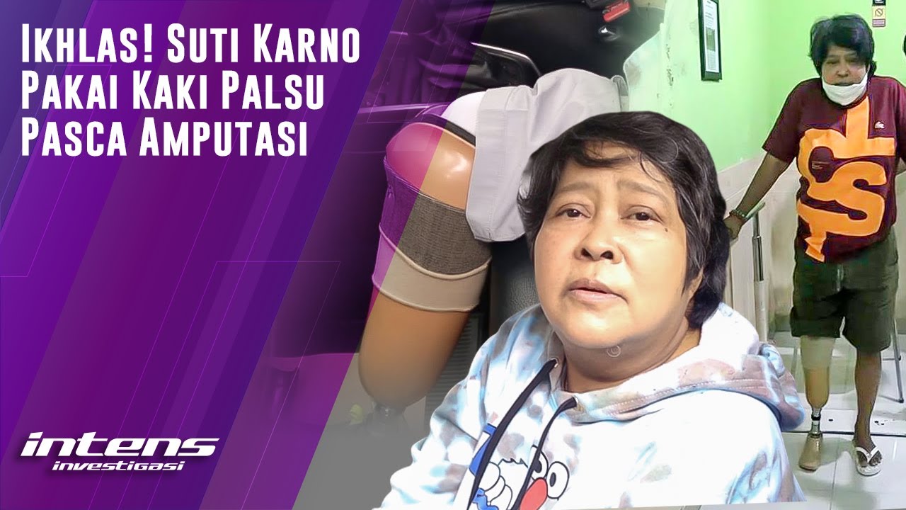 Suti Karno Ikhlas & Beradaptasi Pakai Kaki alsu Usai Diamputasi