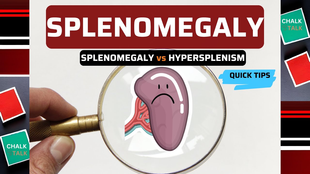 SPLENOMEGALY (ENLARGEMENT OF THE SPLEEN)
