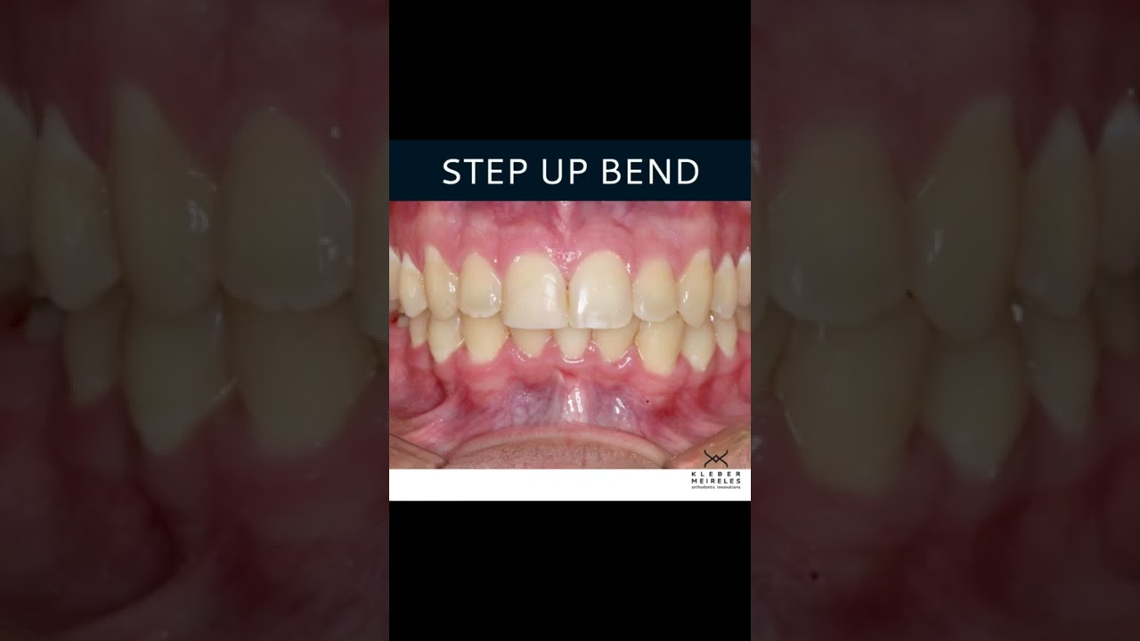 STEP UP BEND - ORTHODONTIC TIPS #Shorts