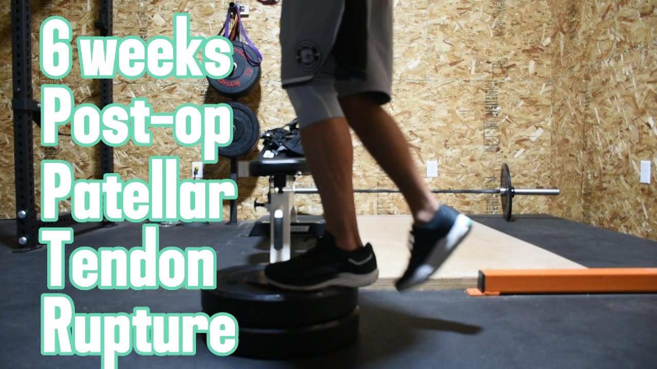 6 Weeks Patellar tendon rupture surgery update