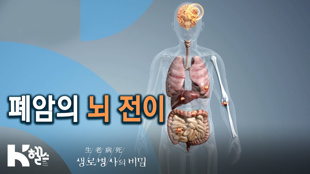 폐암의 뇌 전이 - 폐암, 속도전으로 맞서라 (KBS_746회_2020.09.23)