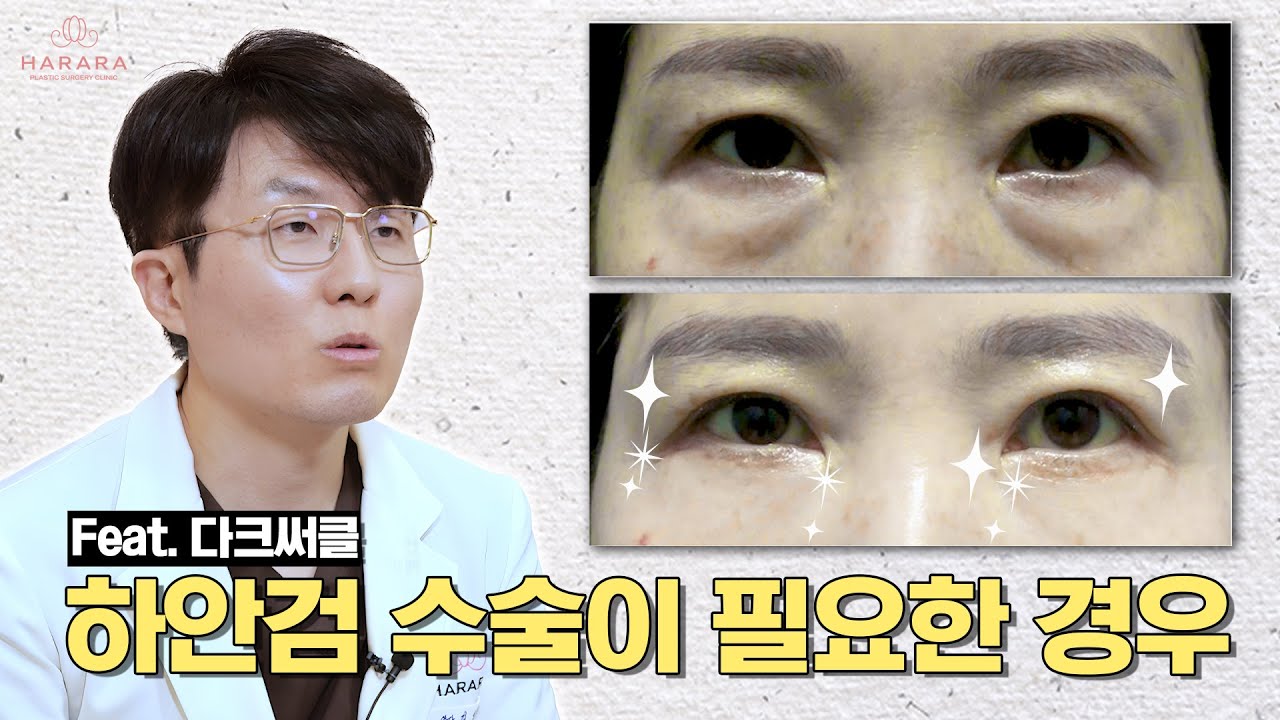 눈밑지방재배치 vs 하안검 전격비교! 고민되는 당신을 위한 영상