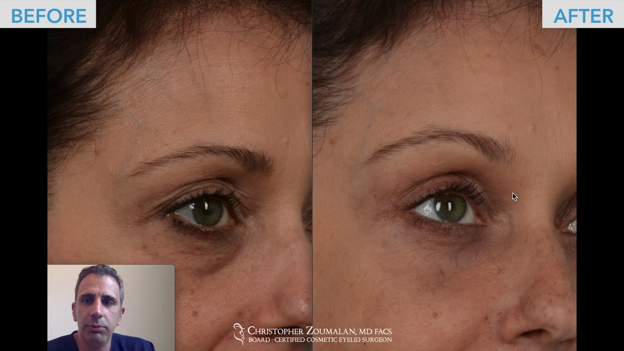 Endoscopic brow lift and quad blepharoplasty in a beautiful female