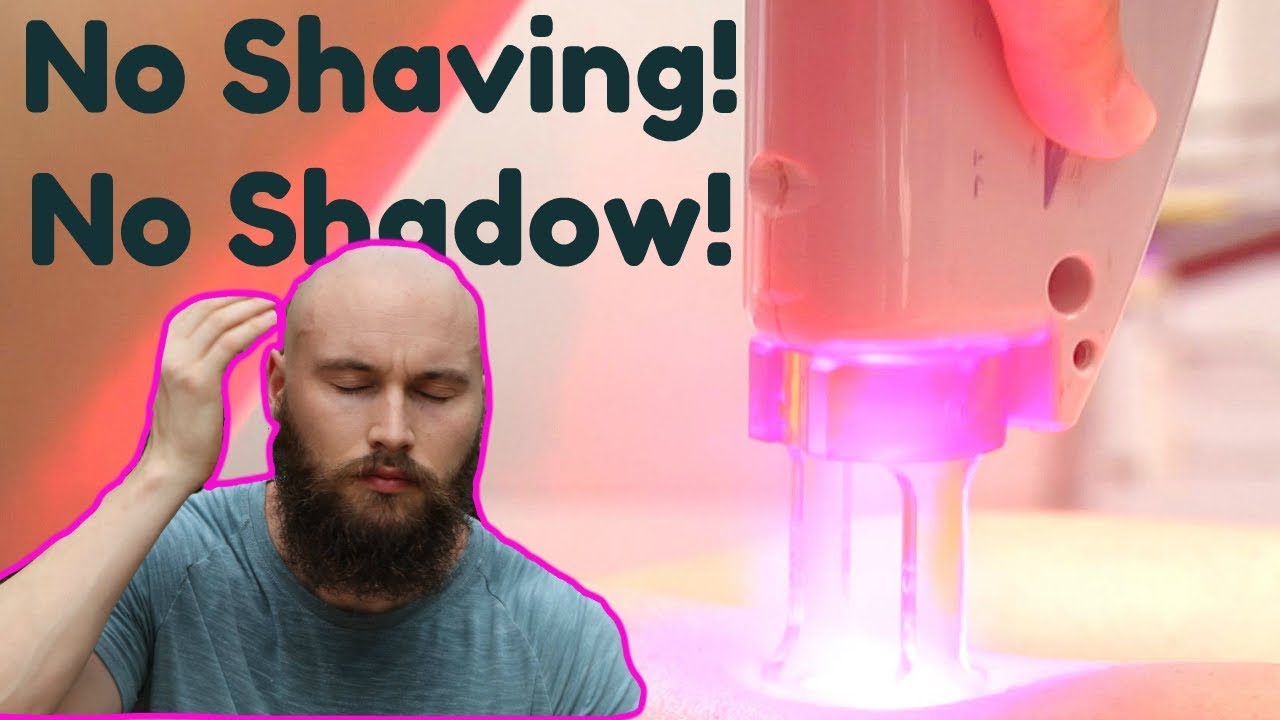 SCALP LASER HAIR REMOVAL FOR A BALD HEAD - Cost? Is it Permanent?