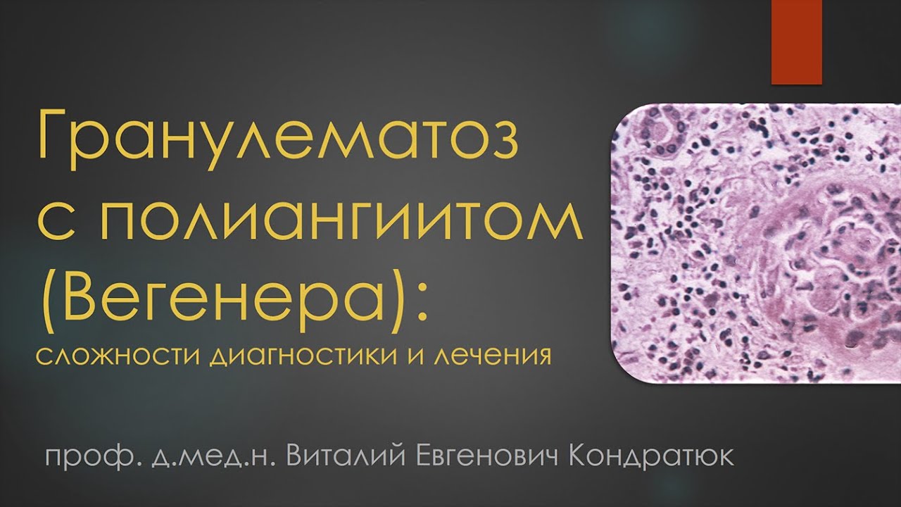 Гранулематоз с полиангиитом (Вегенера): сложности диагностики и лечения