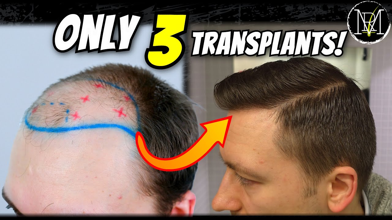 Why 1 Transplant Wasn’t Enough (My Hair Journey)