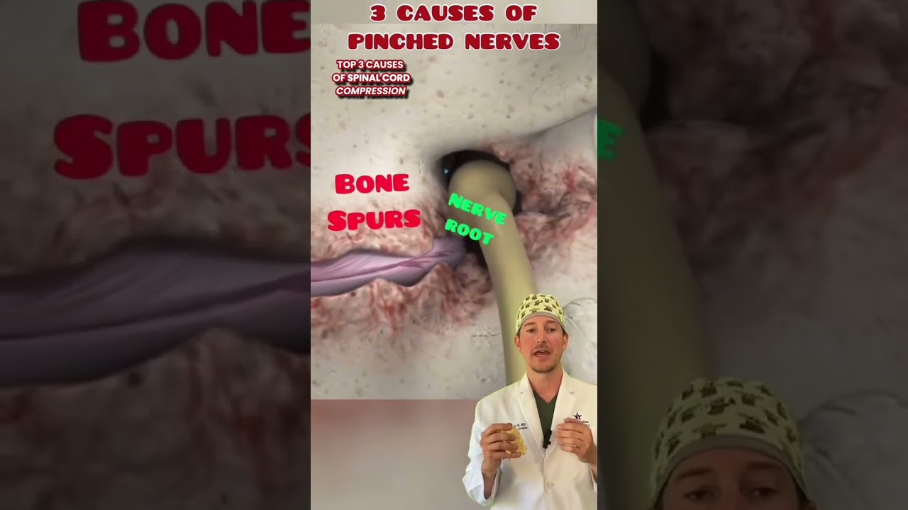 Top 3 Causes for Spinal Cord Compression 👀😱😳