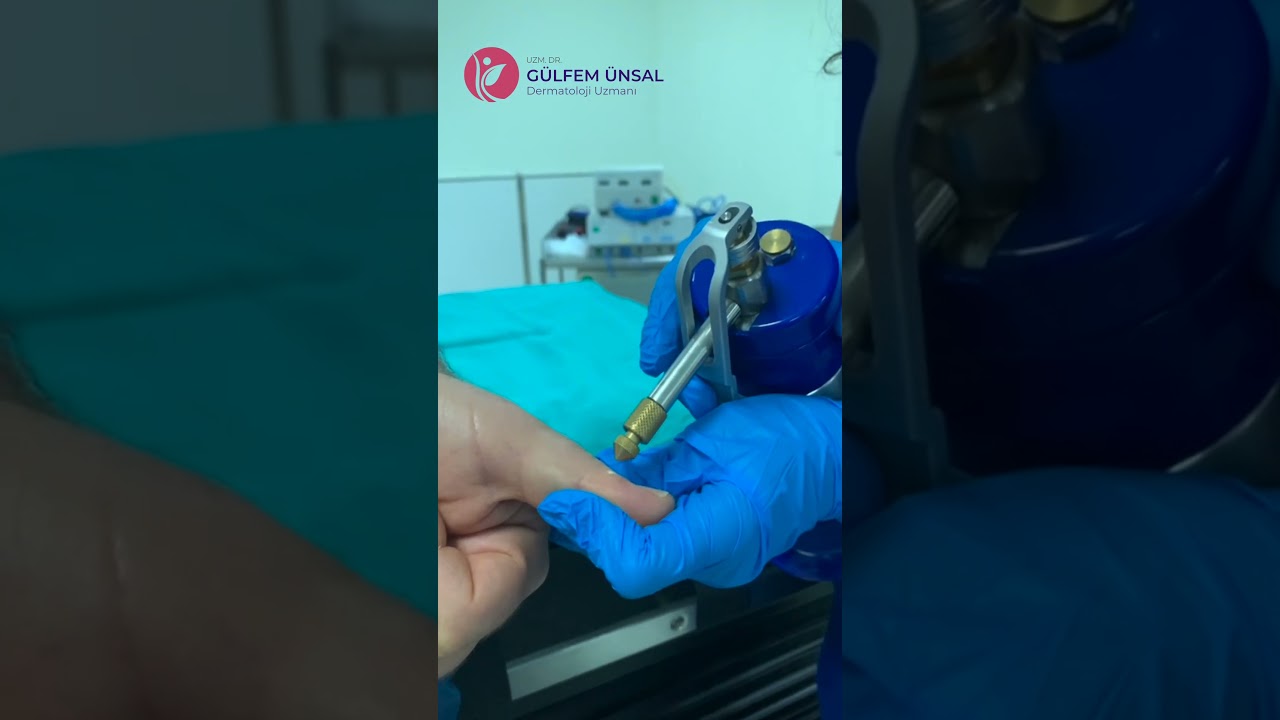 Kriyoterapi ile Siğil Tedavisi - Uzm. Dr. Gülfem Ünsal
