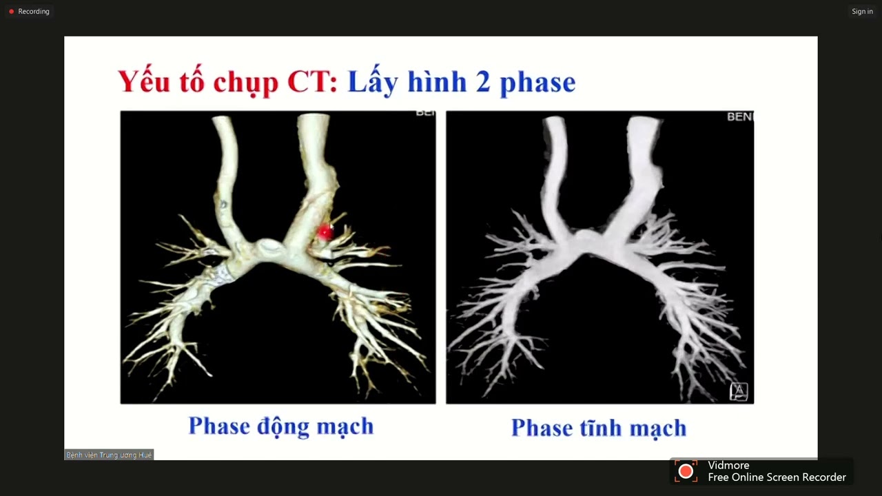 ỨNG DỤNG CHỤP MSCT TRONG BỆNH LÝ TIM BẨM SINH | ThS. BS. Dương Phi Sơn
