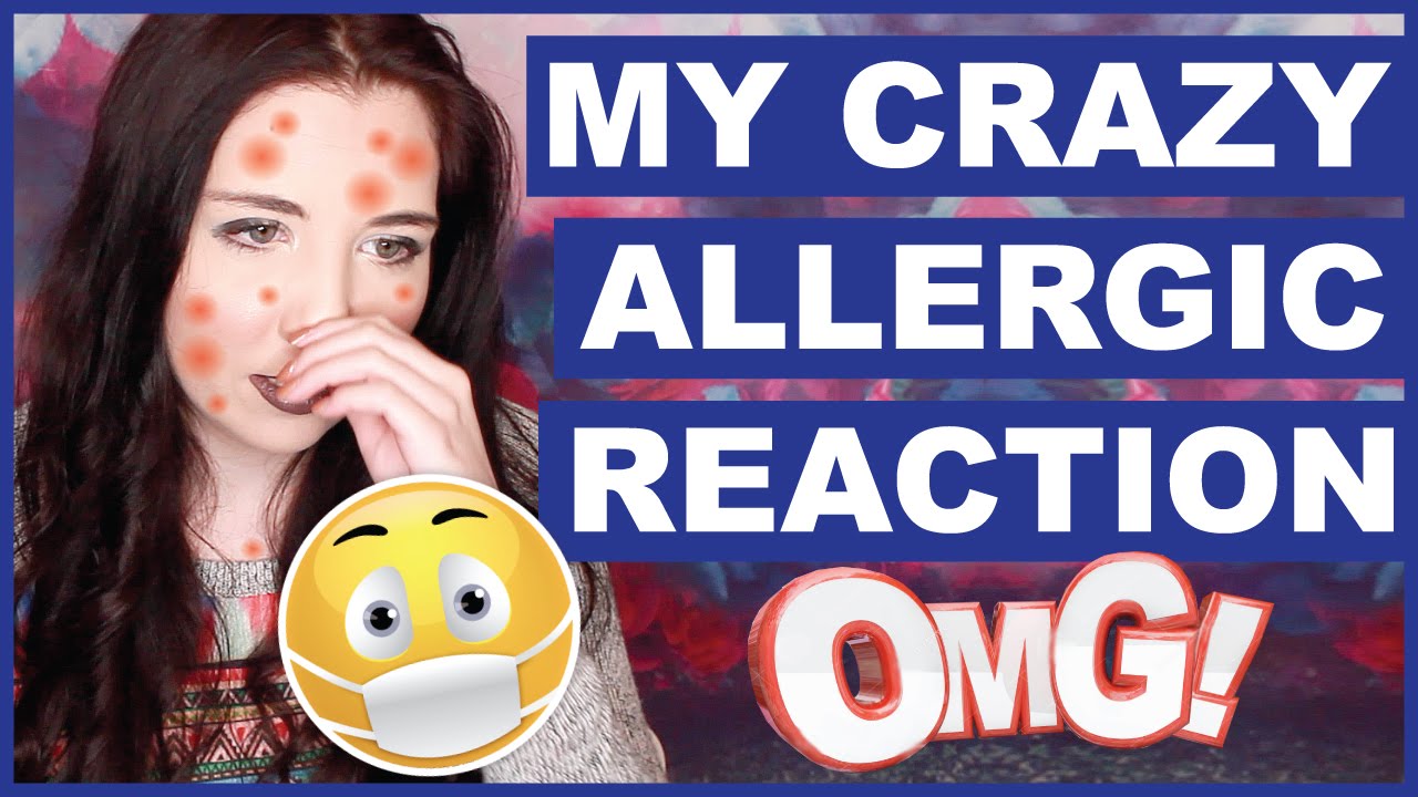 My Crazy Allergic Reaction