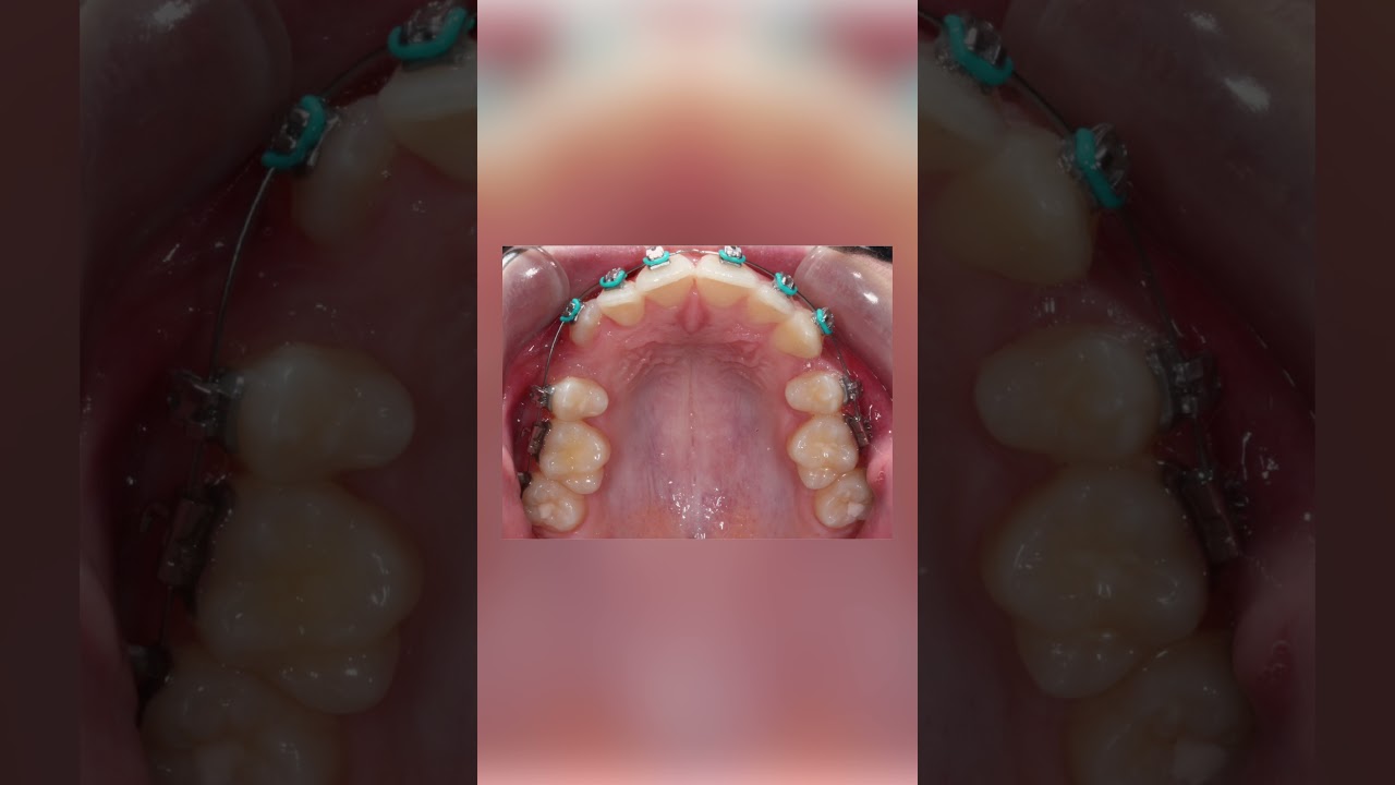 Braces Changes Timelapse of the Upper teeth with Extractions - TheBracesDoc