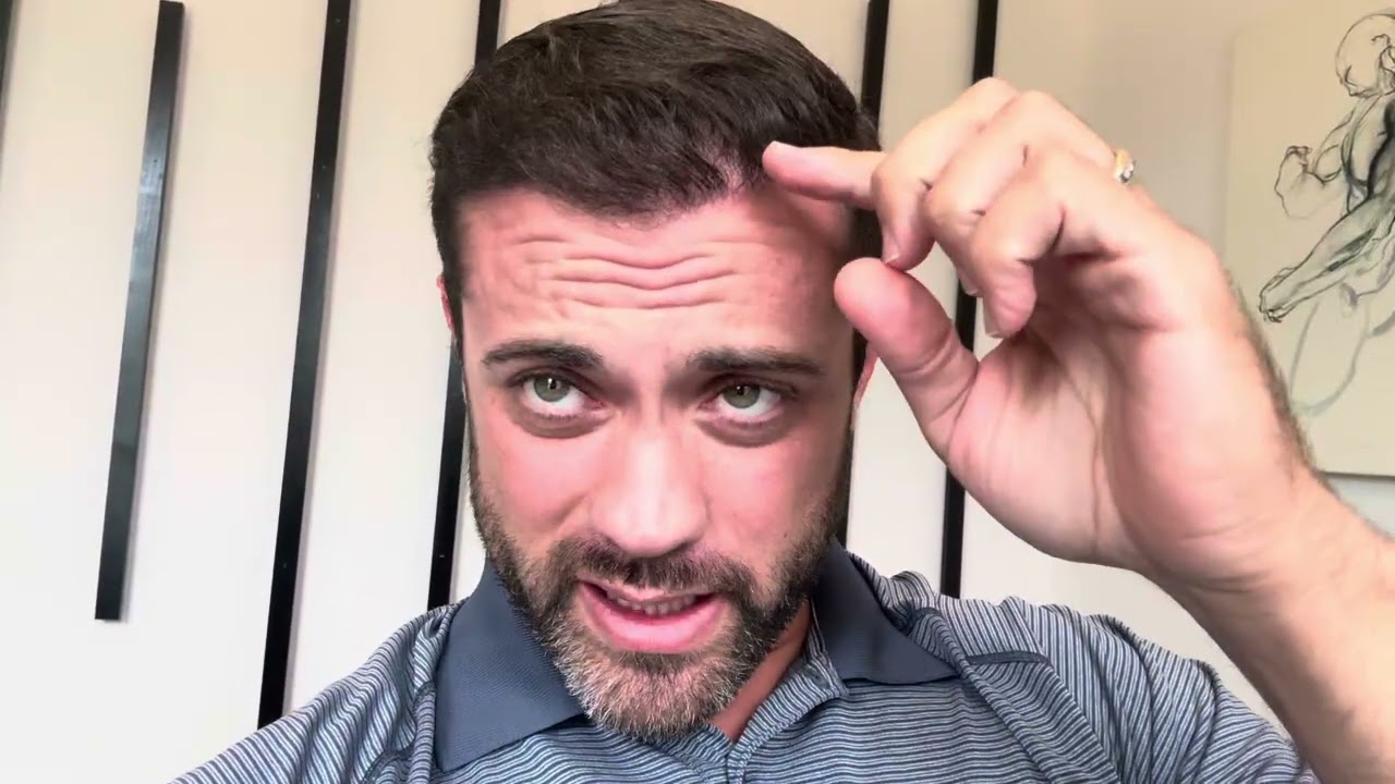 Month 5 Post Hair Transplant - Cosmedica - Istanbul, Turkey