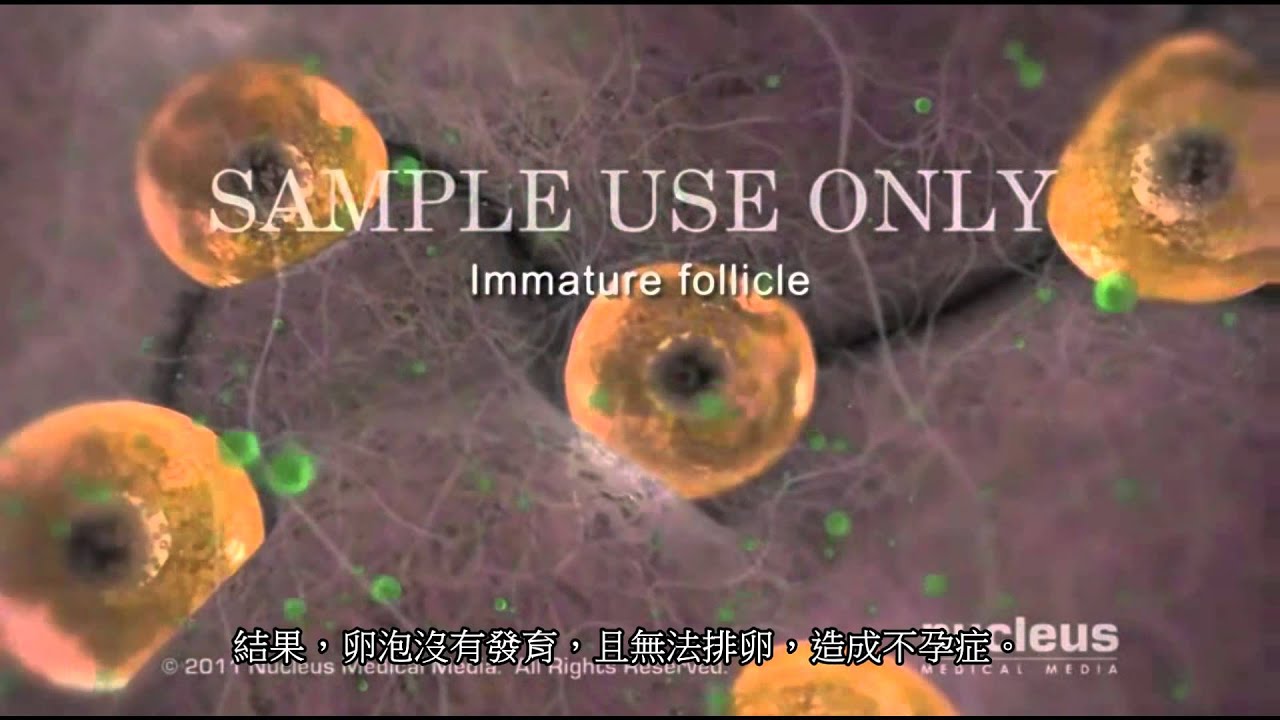 多囊性卵巢症候群