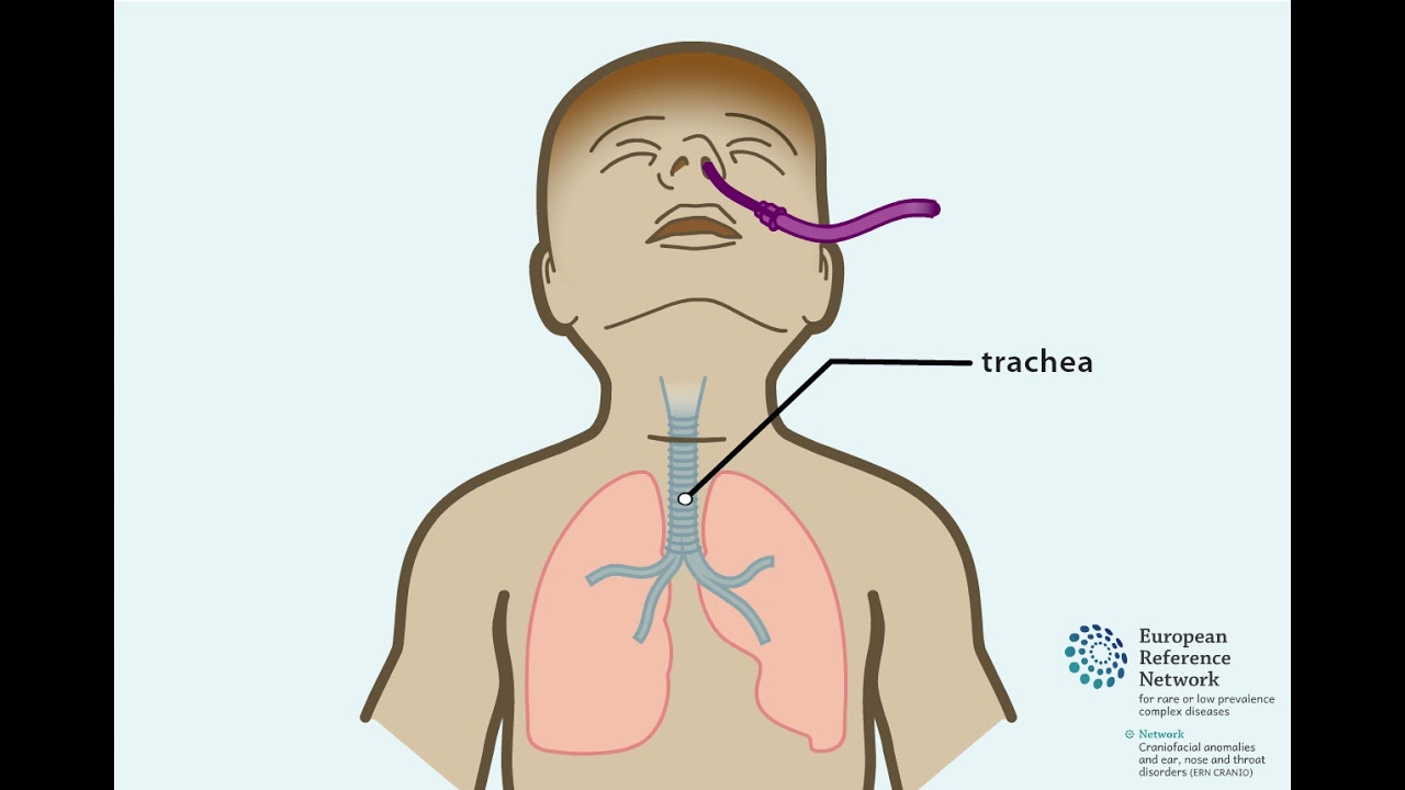 Tracheotomie bij kinderen [in het Nederlands]