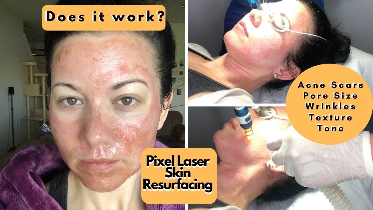 Pixel Laser Treatment For Acne Scars & Big Pores