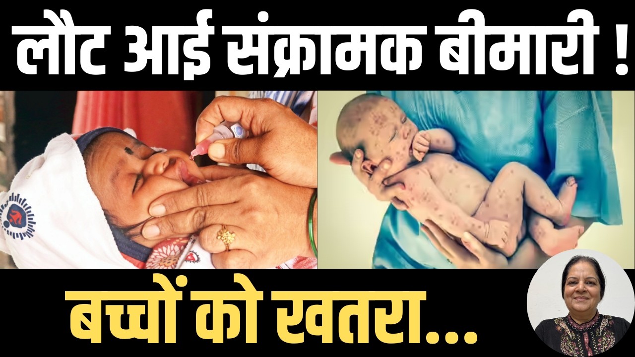 Measles outbreak: लक्षणों को नजरअंदाज न करें | सावधानी, जागरूकता और वैक्सीनेशन से ही रुक सकता