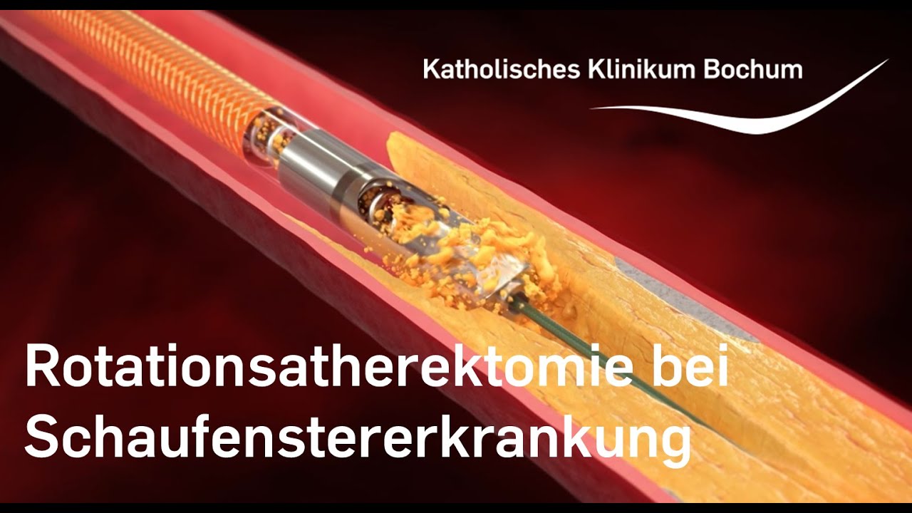 Rotationsatherektomie bei Schaufenstererkrankung (pAVK)