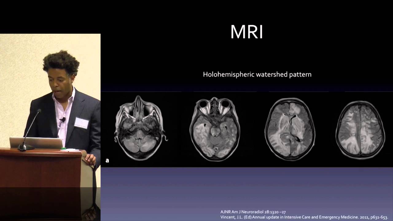Posterior Reversible Encephalopathy Syndrome (PRES): Who, What When? by Tommy T. Thomas, MD, PhD