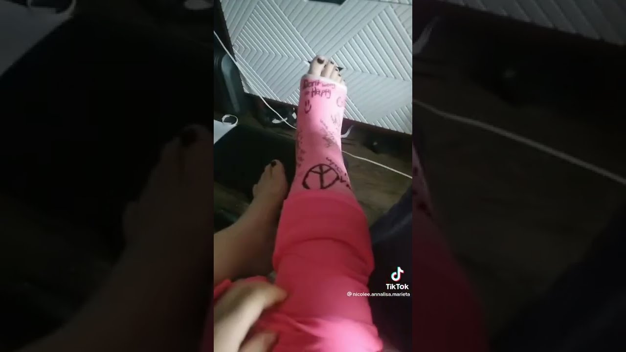 SHORT LEG CAST PINK 😍#legcast