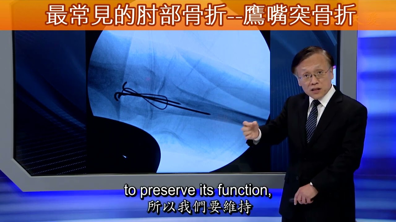 最常見的肘部骨折--鷹嘴突骨折【大愛醫生館精選】