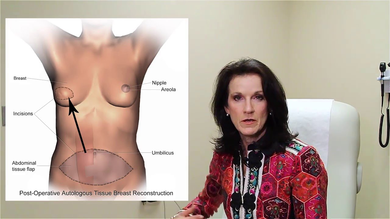 Options for Breast Reconstruction after Mastectomy? Ask the Doctor